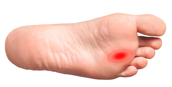 neuroma di morton
