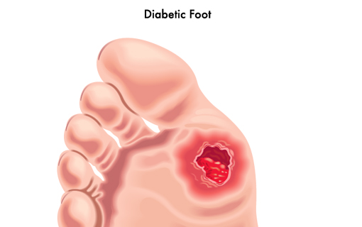 piede diabetico